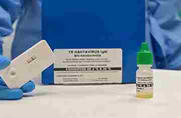  Novo teste faz diagnóstico de hantavirose em 20 minutos 